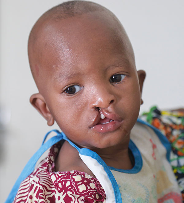 Mariela, open-heart surgery in Madagascar