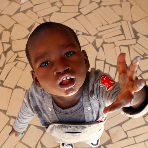 Enfant burkinabè soigné par La Chaîne de l'Espoir