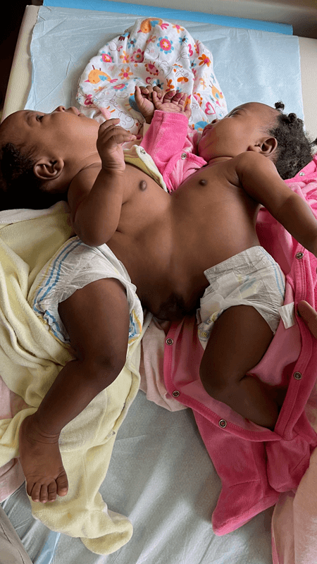 Siamese twins Ketsia and Kimberly await much-needed surgery